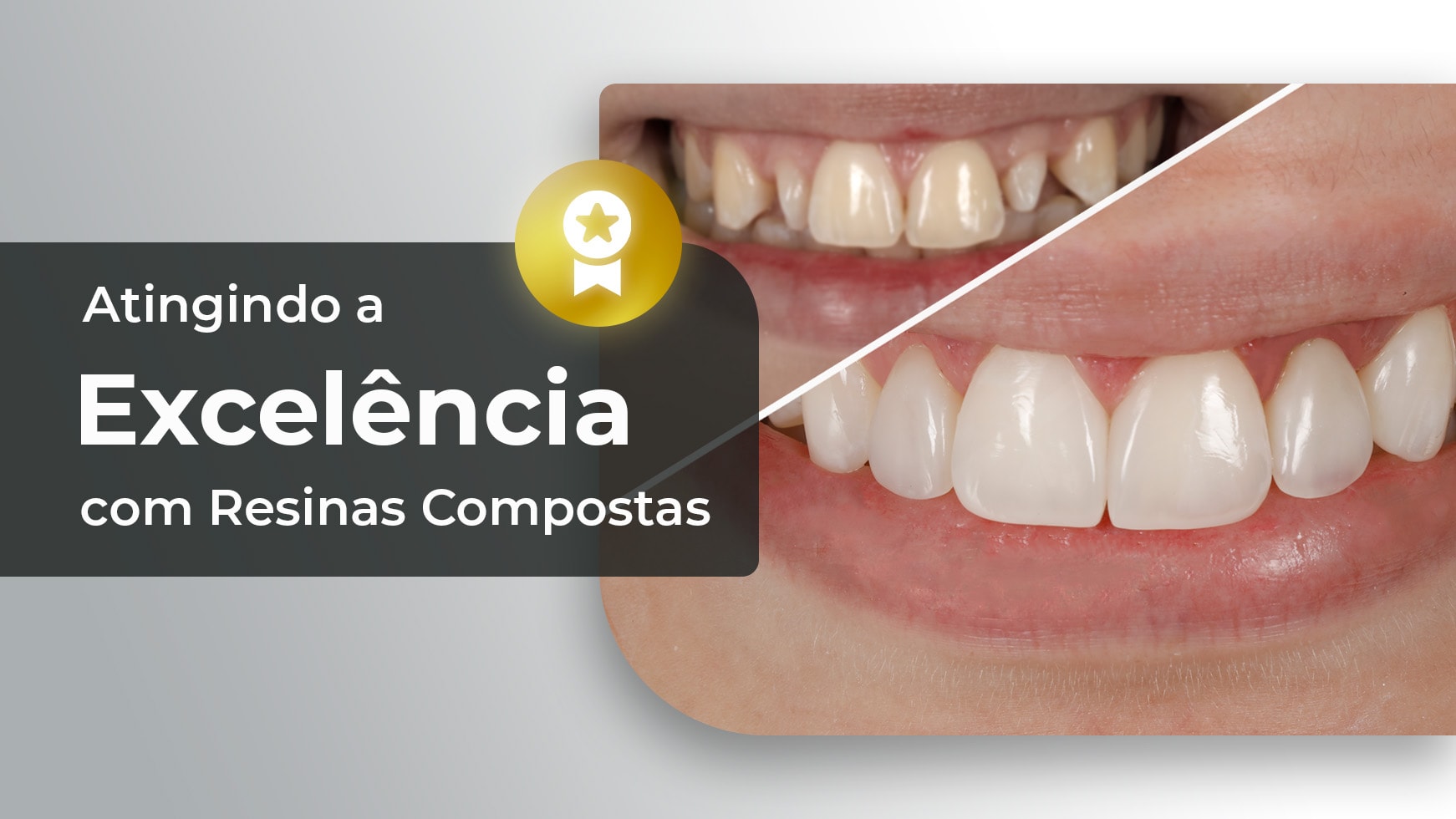 Atingindo a Excelência com Resinas Compostas