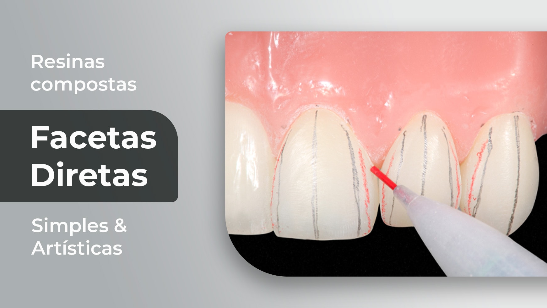 Facetas Diretas em Resinas Compostas: Simples & Artísticas