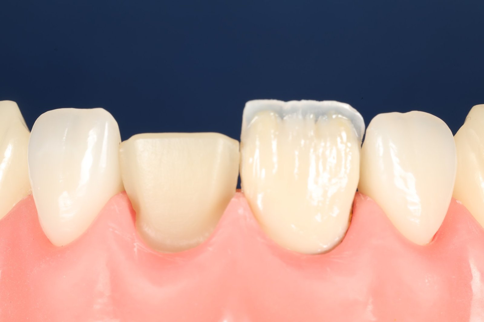 Etapa de estratificação de facetas em dentes escurecidos