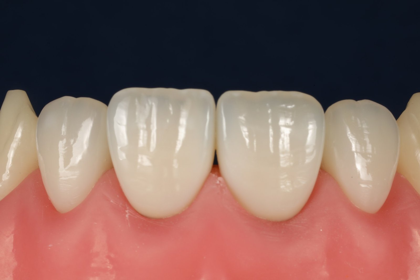 Acabamento e polimento de facetas em dentes escurecidos