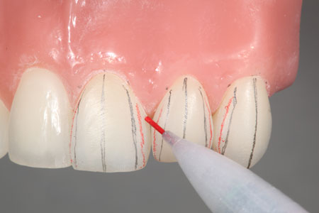 Anatomia aplicada às facetas diretas