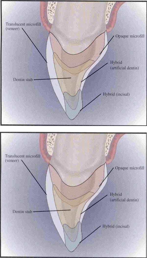 Publicação Protocol for Predictable Restoration of Anterior Teeth with Composite Resins